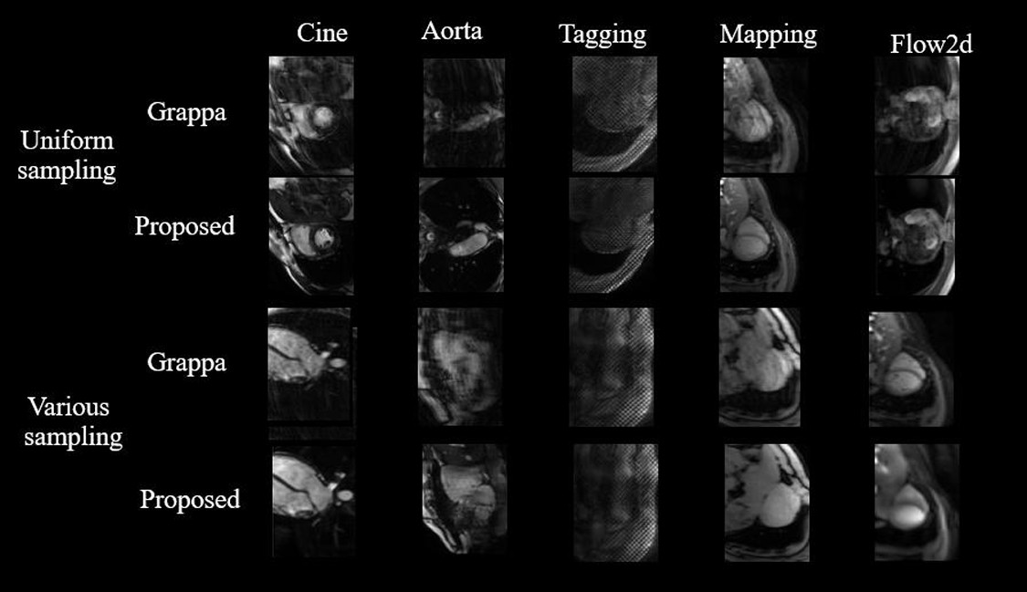 Cardiac MRI reconstruction result