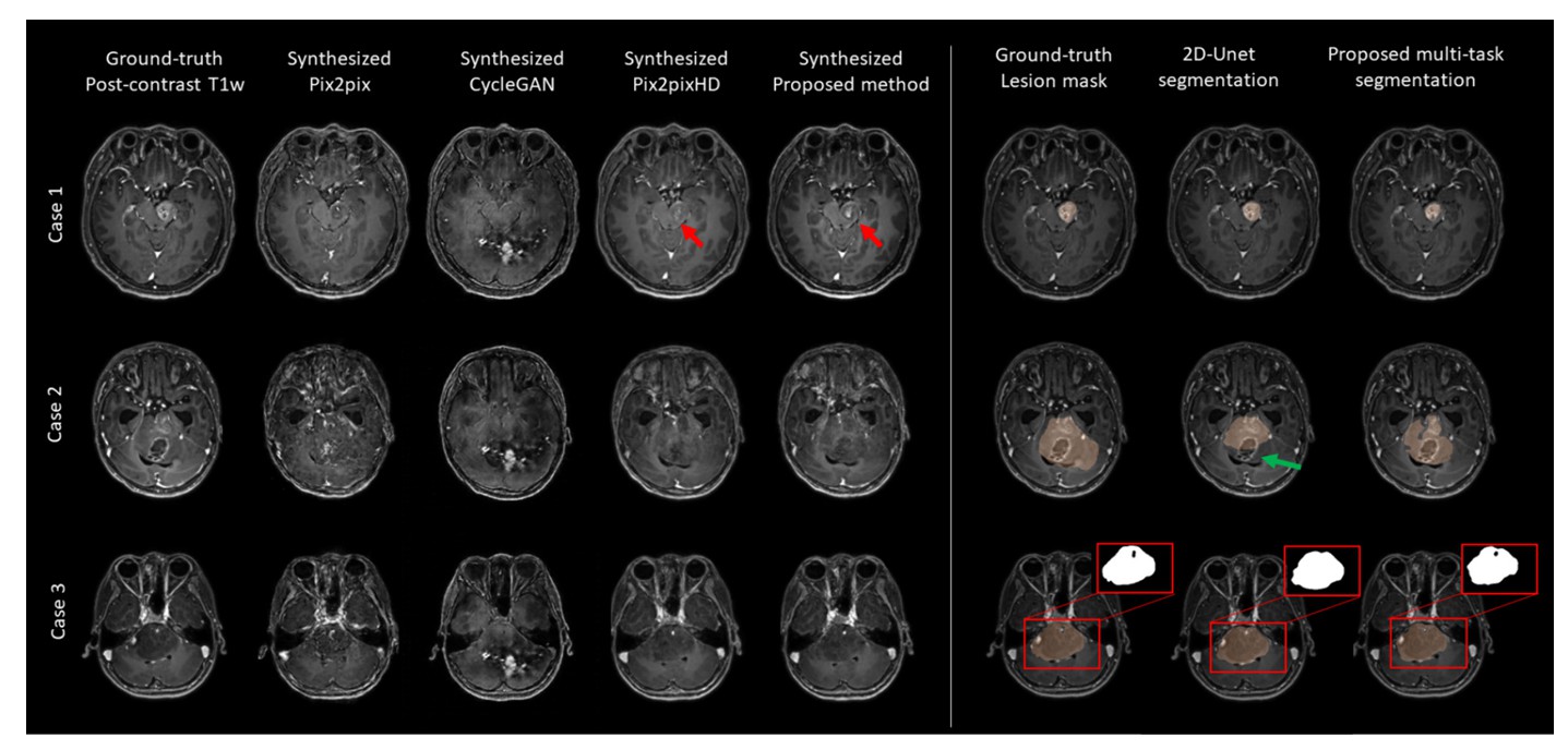 Tumor segmentation result